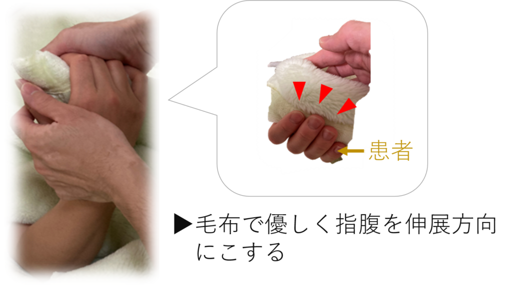 手指関節拘縮アプローチ